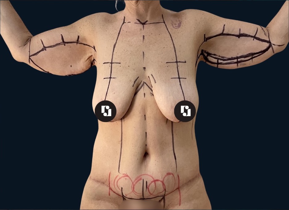 Before — Mastopexy and brachioplasty in stages