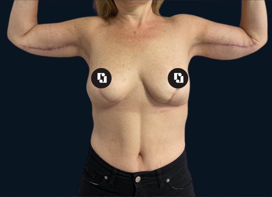 After — Mastopexy and brachioplasty in stages