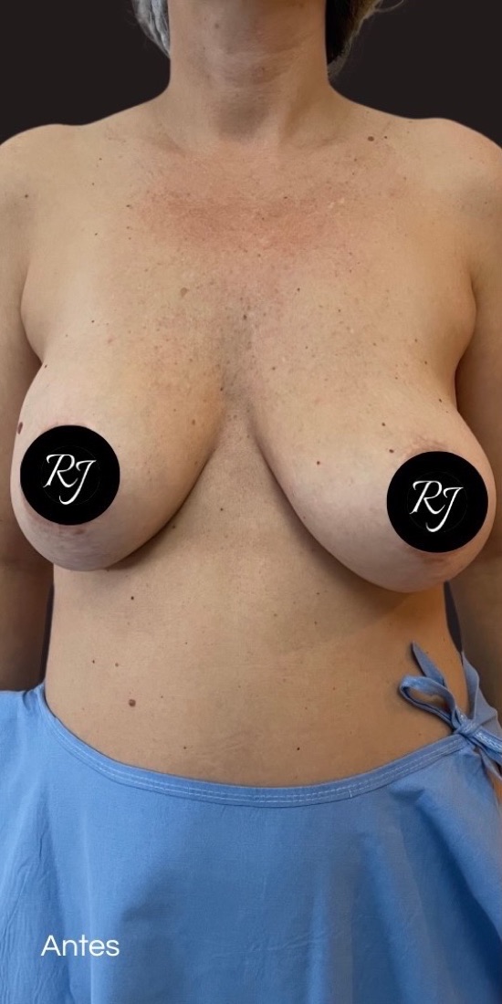 Before — Implant removal combined with mastopexy