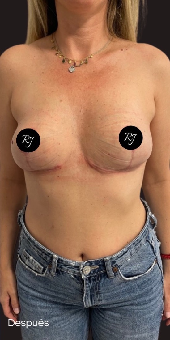 After — Implant removal combined with mastopexy