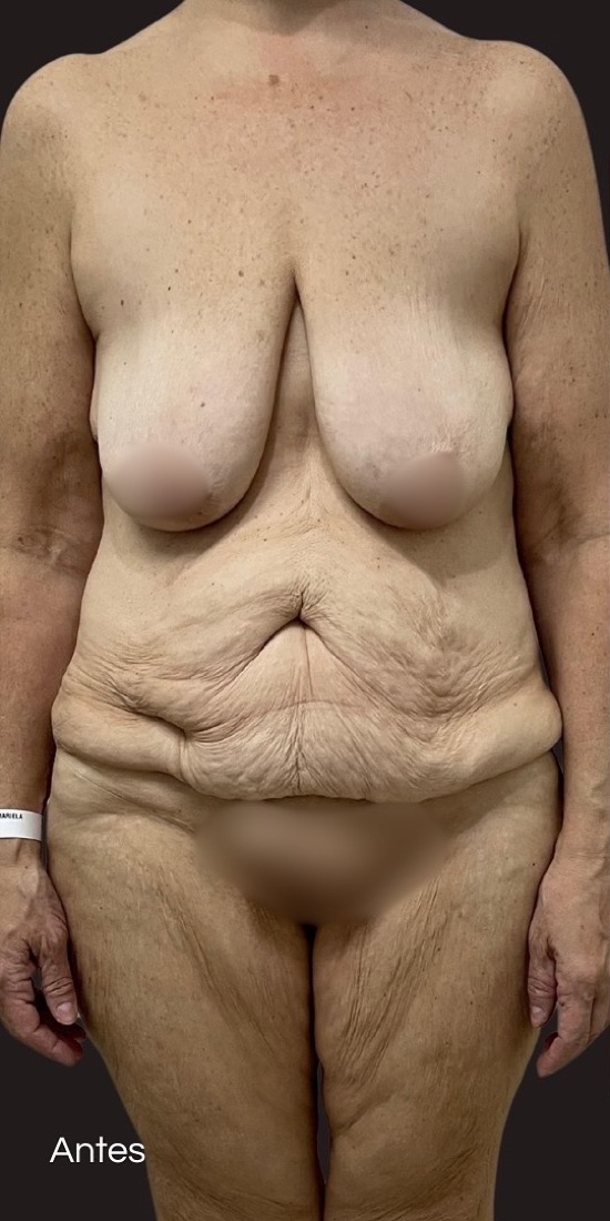 Before — 80 kg lost: reconstruction in stages