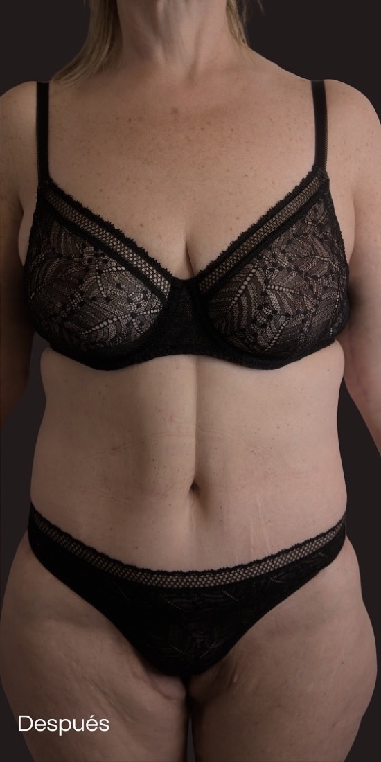 After — 80 kg lost: reconstruction in stages