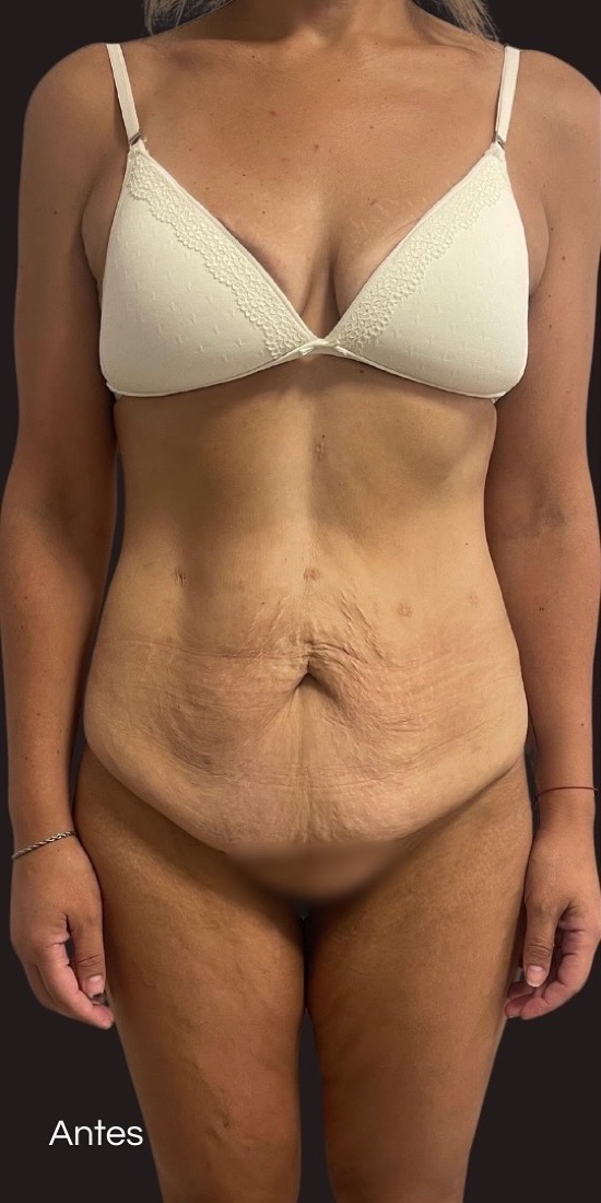 Before — 360 dermolipectomy with muscle volumisation
