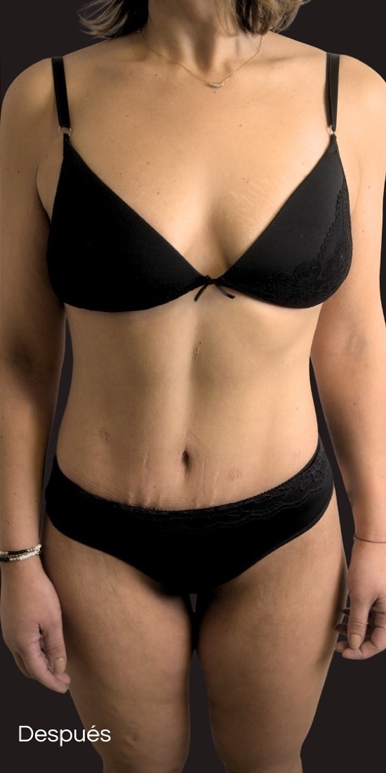 After — 360 dermolipectomy with muscle volumisation