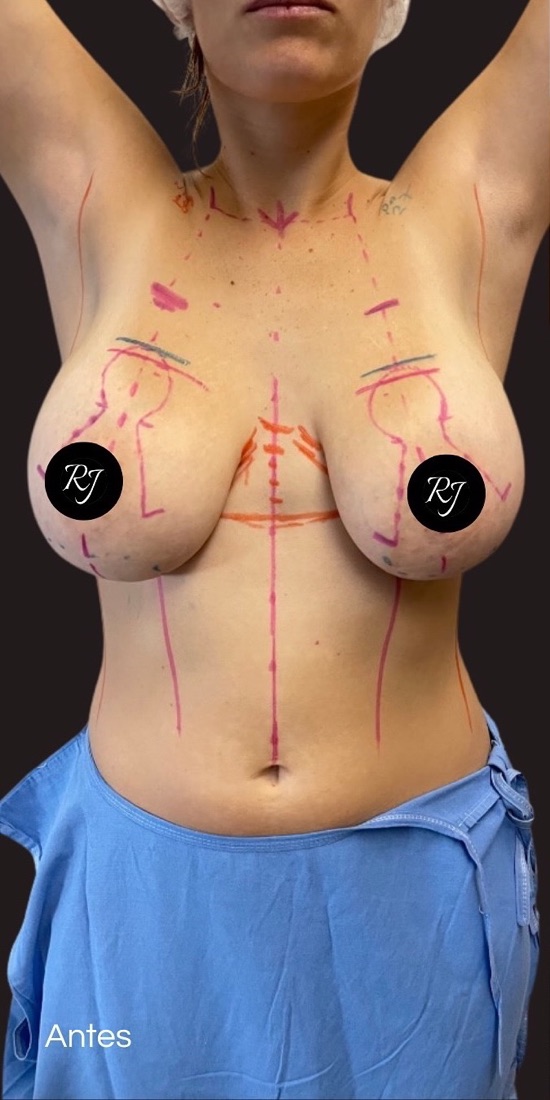 Before — Breast reduction and multi-plane mastopexy
