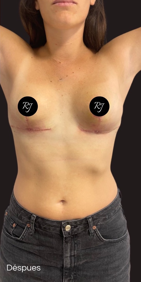After — Breast reduction and multi-plane mastopexy