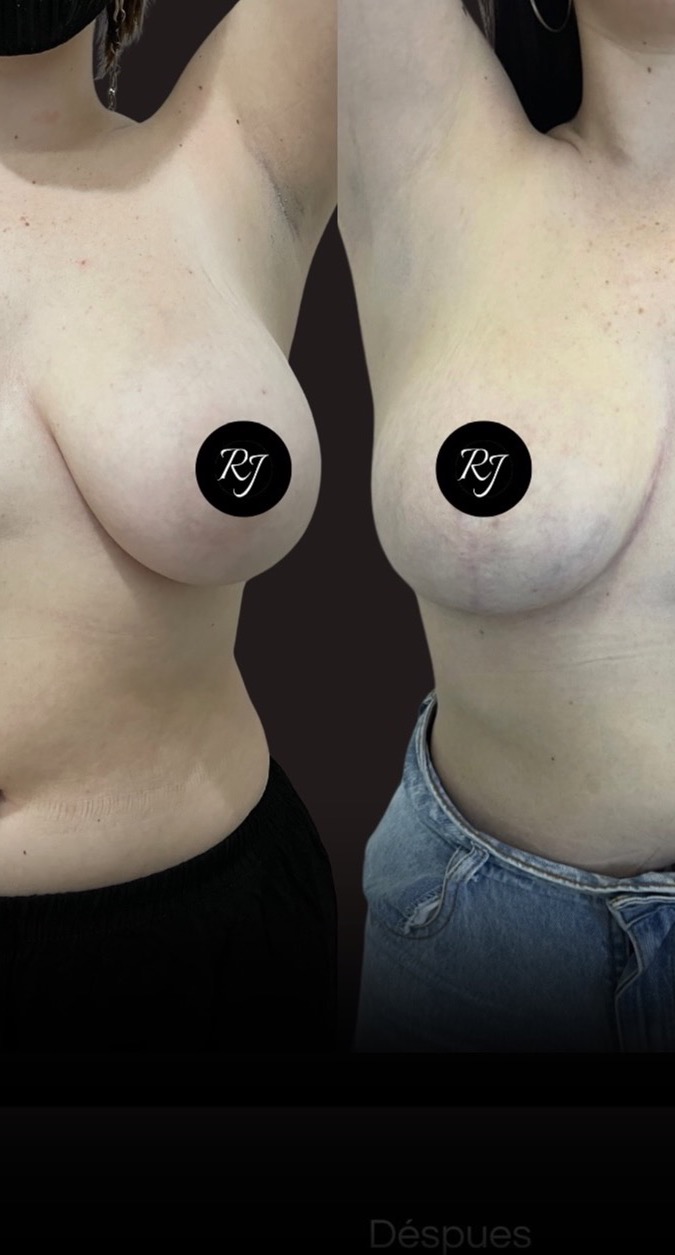 Before — Breast reduction with inverted-T mastopexy