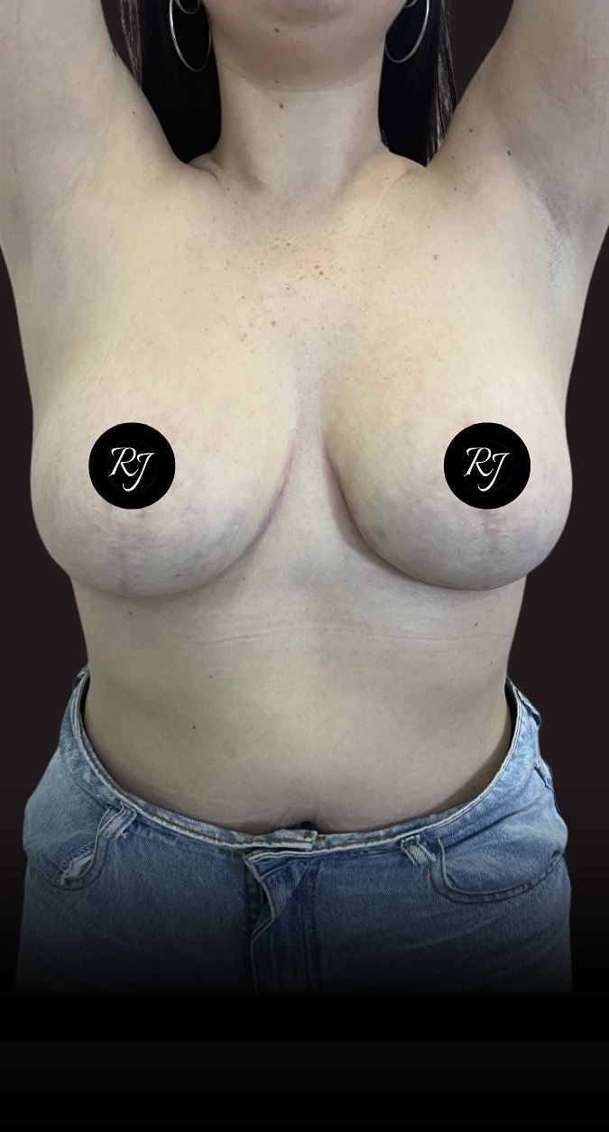 After — Breast reduction with inverted-T mastopexy
