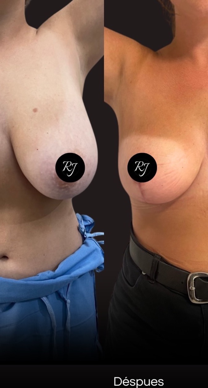 Before — Breast reduction with structured mastopexy