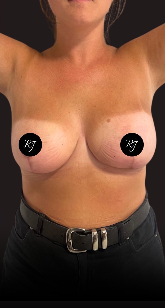 After — Breast reduction with structured mastopexy
