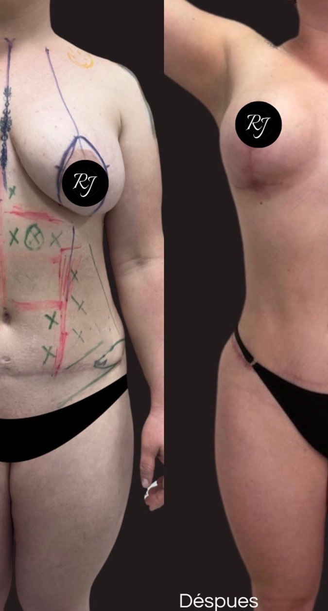 Before — 360 liposculpture with dermolipectomy and mastopexy