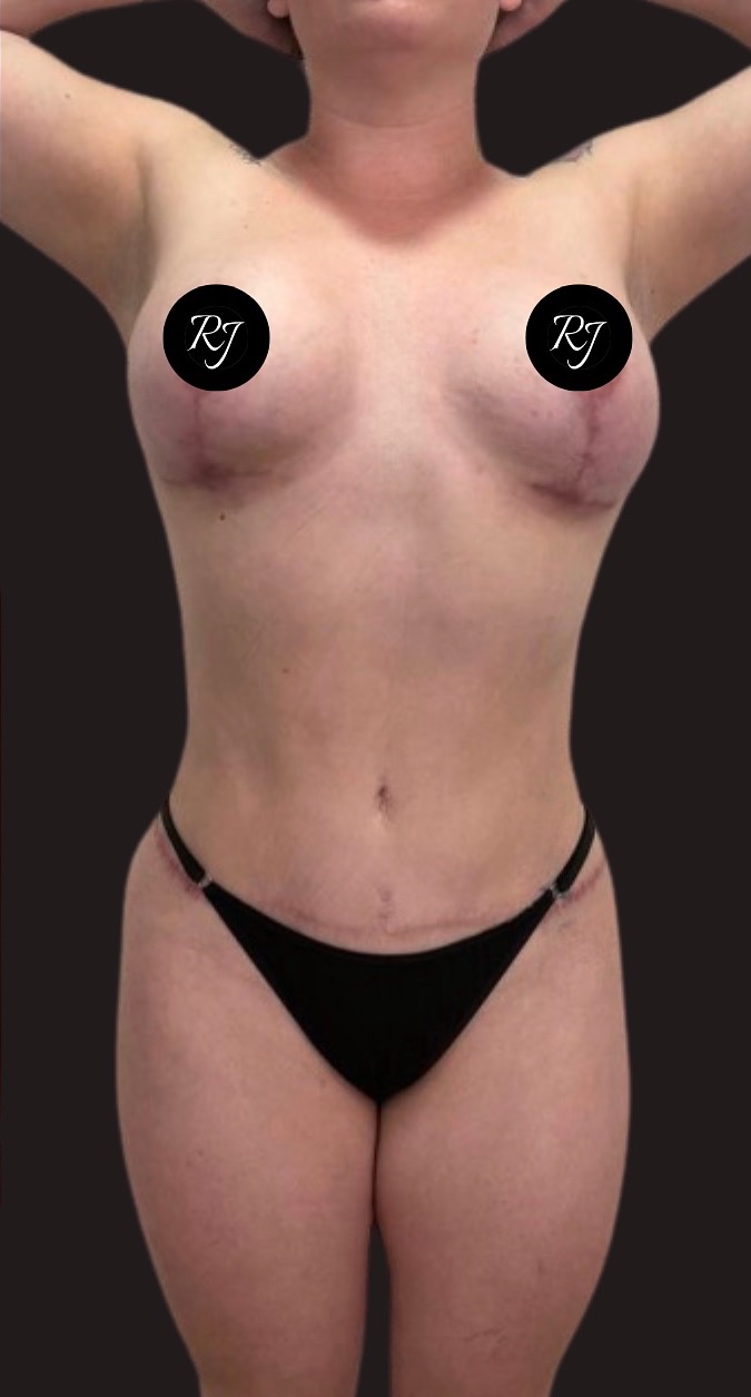 After — 360 liposculpture with dermolipectomy and mastopexy