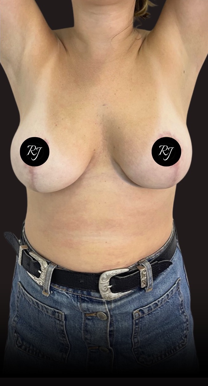 After — Inverted-T mastopexy, no implants
