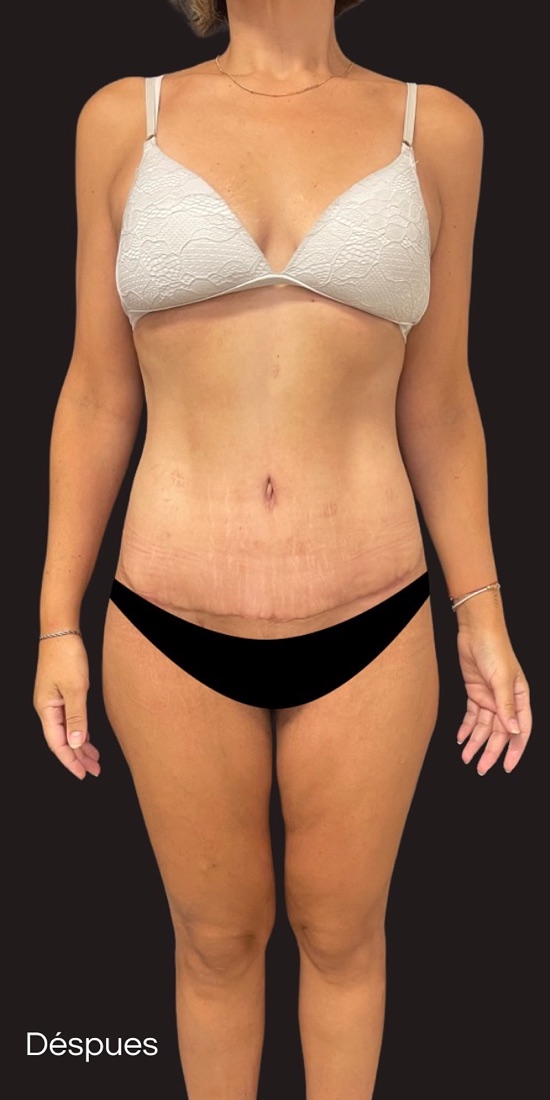After — 53 kg lost after gastric bypass