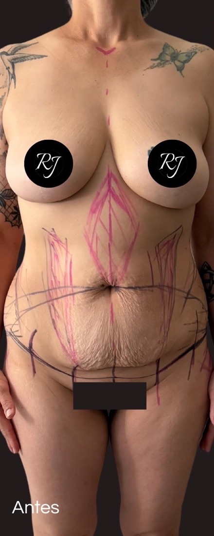 Before — Dermolipectomy and body contouring