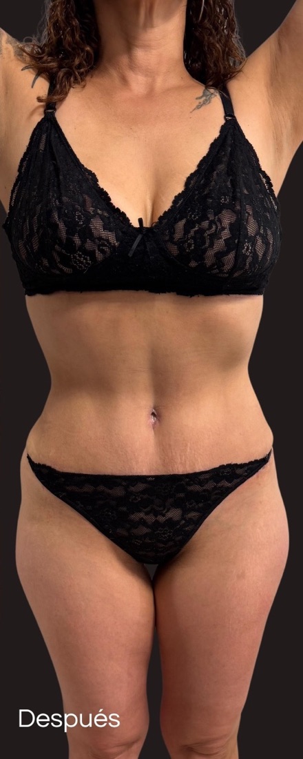 After — Dermolipectomy and body contouring